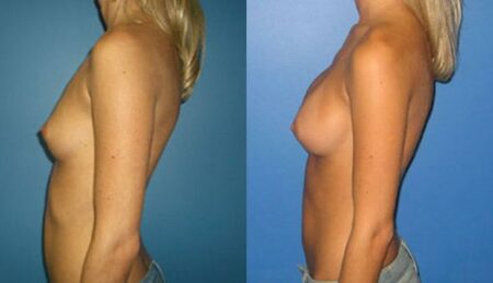 patient-10956-breast-augmentation-before-after-4
