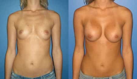 patient-10956-breast-augmentation-before-after