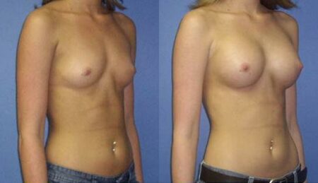 patient-10967-breast-augmentation-before-after-1