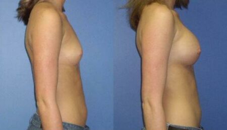 patient-10967-breast-augmentation-before-after-2