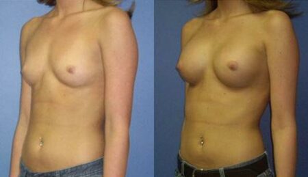 patient-10967-breast-augmentation-before-after-3