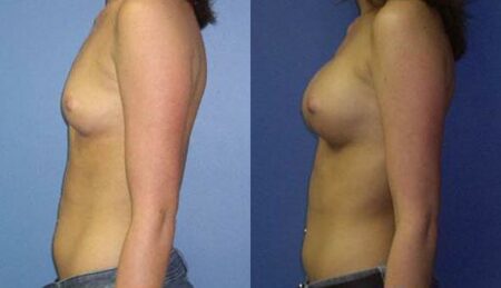 patient-10967-breast-augmentation-before-after-4