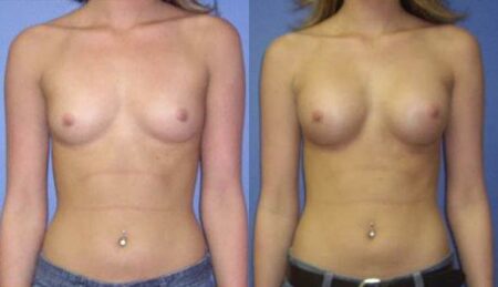 patient-10967-breast-augmentation-before-after