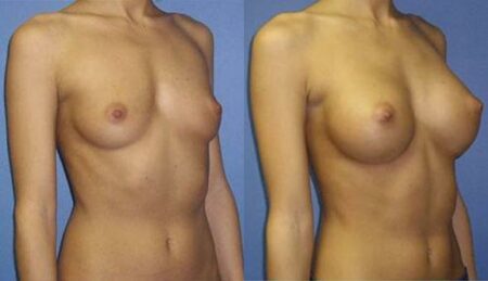 patient-10978-breast-augmentation-before-after-1