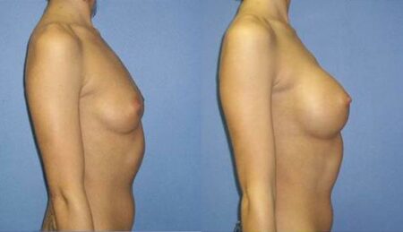 patient-10978-breast-augmentation-before-after-2