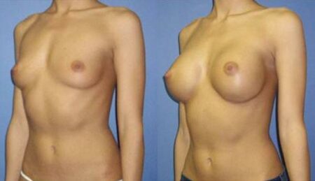 patient-10978-breast-augmentation-before-after-3