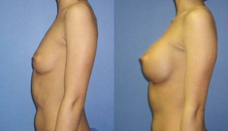 patient-10978-breast-augmentation-before-after-4