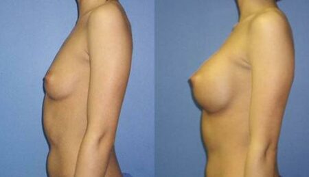 patient-10978-breast-augmentation-before-after-4