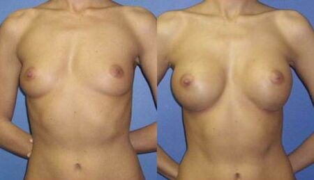 patient-10978-breast-augmentation-before-after