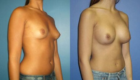 patient-10989-breast-augmentation-before-after-1