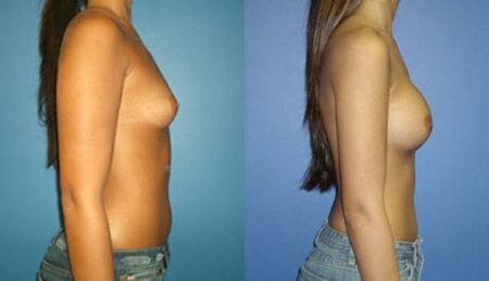 patient-10989-breast-augmentation-before-after-2