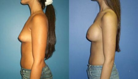 patient-10989-breast-augmentation-before-after-3