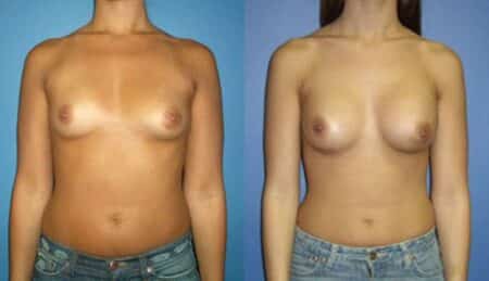 patient-10989-breast-augmentation-before-after