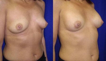 patient-10998-breast-augmentation-before-after-1