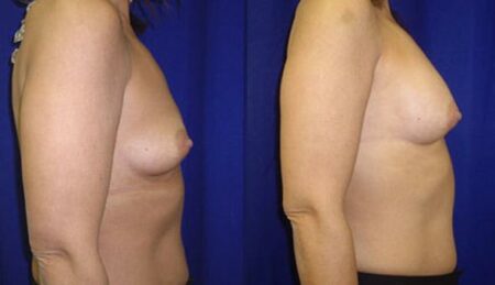 patient-10998-breast-augmentation-before-after-2