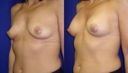 patient-10998-breast-augmentation-before-after-3