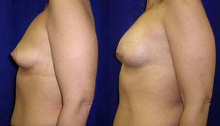 patient-10998-breast-augmentation-before-after-4