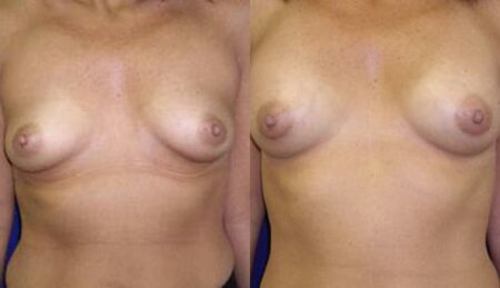 patient-10998-breast-augmentation-before-after