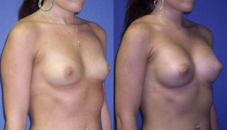 patient-11009-breast-augmentation-before-after-1