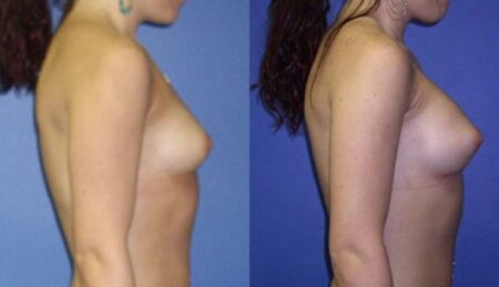 patient-11009-breast-augmentation-before-after-2