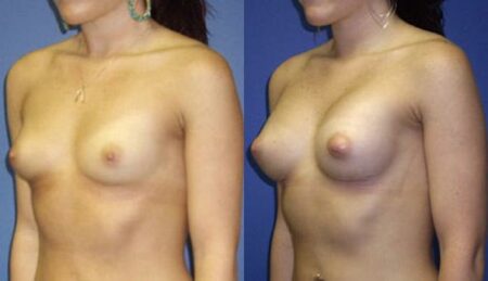 patient-11009-breast-augmentation-before-after-3