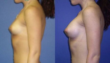 patient-11009-breast-augmentation-before-after-4