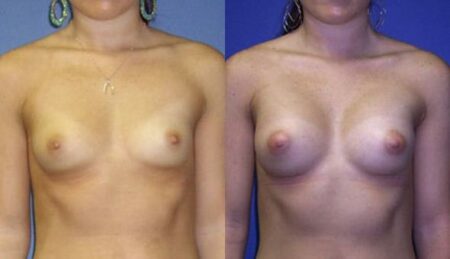 patient-11009-breast-augmentation-before-after