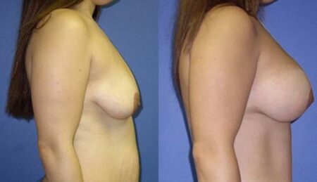 patient-11020-breast-augmentation-before-after-2