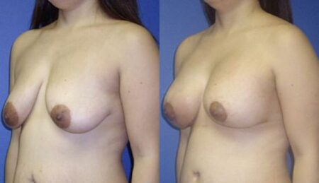 patient-11020-breast-augmentation-before-after-3