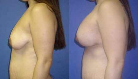 patient-11020-breast-augmentation-before-after-4