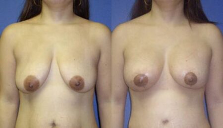 patient-11020-breast-augmentation-before-after