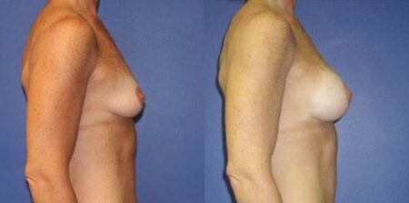 patient-11031-breast-augmentation-before-after-1