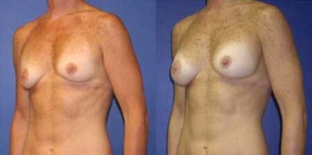 patient-11031-breast-augmentation-before-after-2