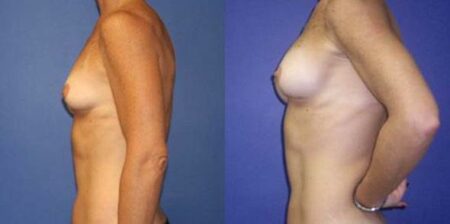 patient-11031-breast-augmentation-before-after-3