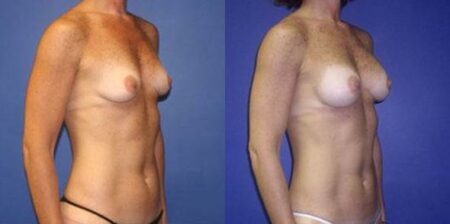 patient-11031-breast-augmentation-before-after