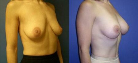 patient-11040-breast-augmentation-before-after-1