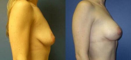 patient-11040-breast-augmentation-before-after-2