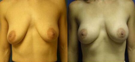 patient-11040-breast-augmentation-before-after