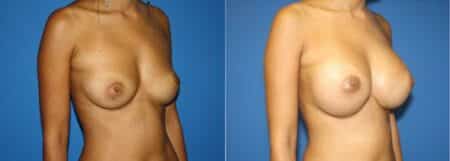 patient-11047-breast-augmentation-before-after-1