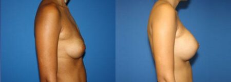 patient-11047-breast-augmentation-before-after-2