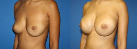 patient-11047-breast-augmentation-before-after-3