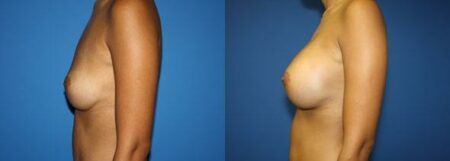 patient-11047-breast-augmentation-before-after-4