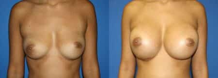 patient-11047-breast-augmentation-before-after