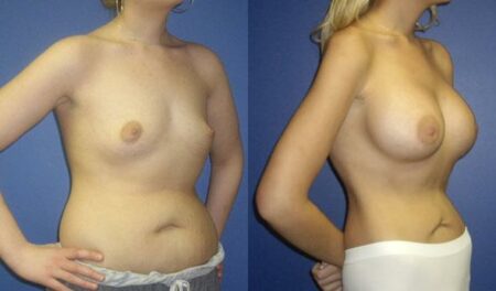 patient-11058-breast-augmentation-before-after-1