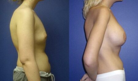 patient-11058-breast-augmentation-before-after-2