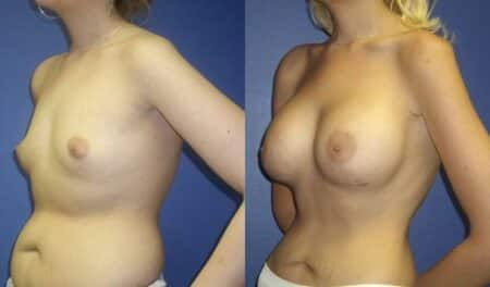 patient-11058-breast-augmentation-before-after-3