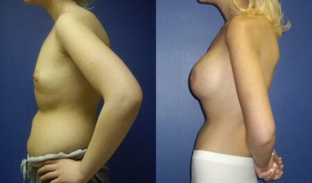 patient-11058-breast-augmentation-before-after-4