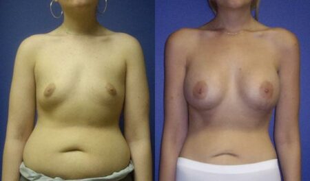 patient-11058-breast-augmentation-before-after