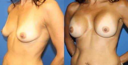 patient-11069-breast-augmentation-before-after-3