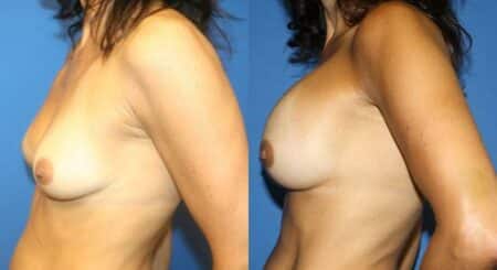 patient-11069-breast-augmentation-before-after-4